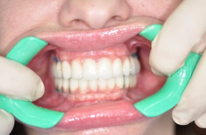 Протезирование челюсти на имплантах при полном отсутствии зубов