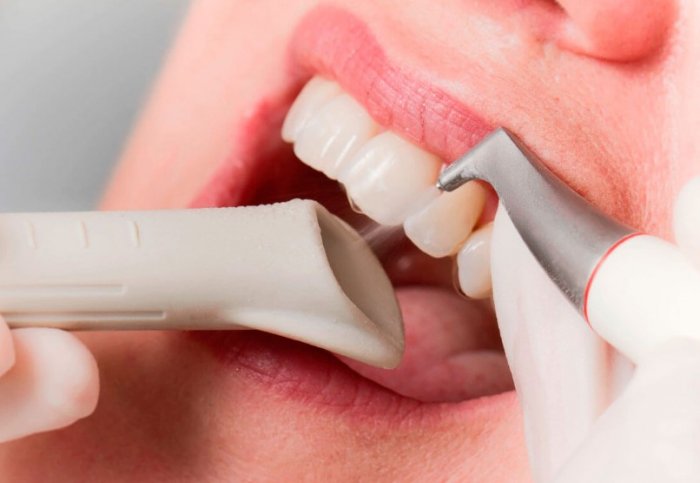 Профессиональная чистка зубов AirFlow: показания и особенности проведения