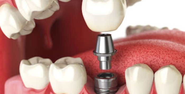 Импланты Дентиум — быстрое восстановление зубного ряда