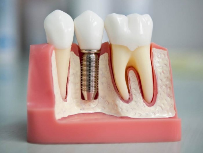 Несъемное протезирование зубов: основные способы и материалы