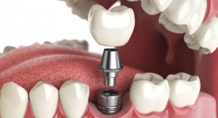 Процедура имплантации зубов под ключ