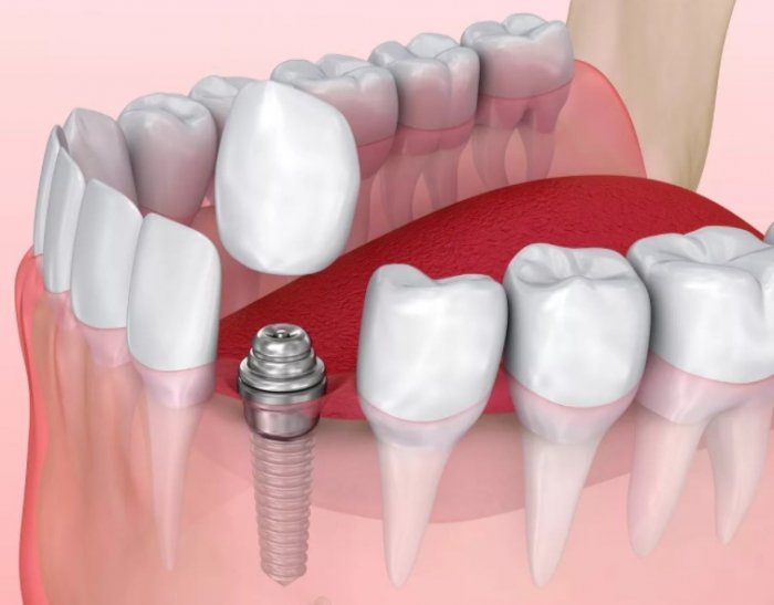 Процедура имплантации зубов