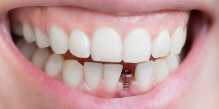 Имплантация зубов в Коньково: основные этапы и противопоказания