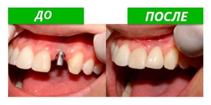 Имплантация зубов в Москве недорого
