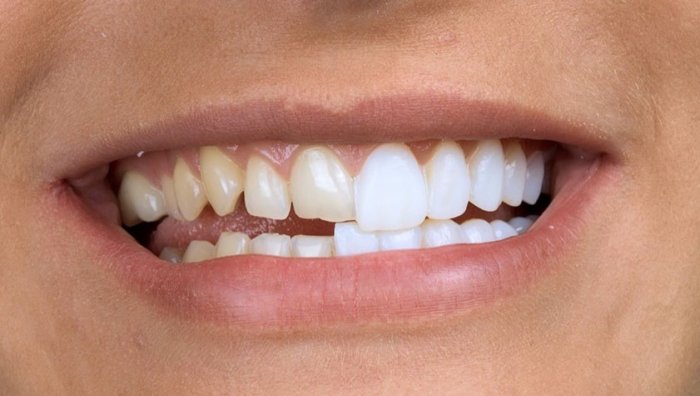 Современный способ реставрации зубов – виниры