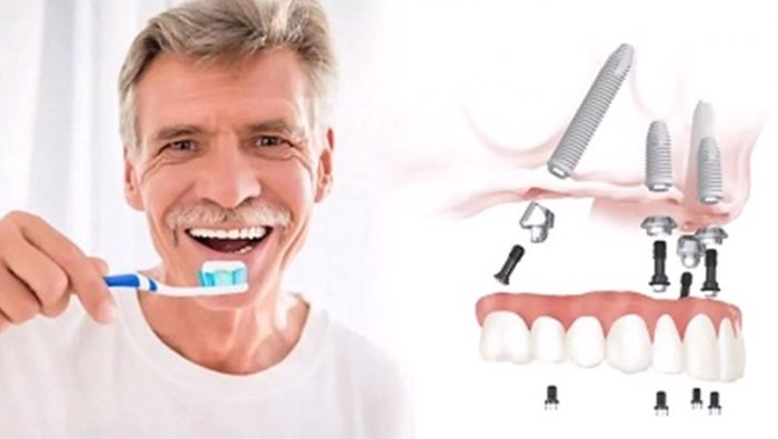 Имплантация зубов по методу all on 4