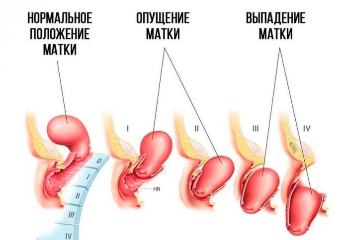 Всё о мышцах тазового дна: причины, симптомы и лечение