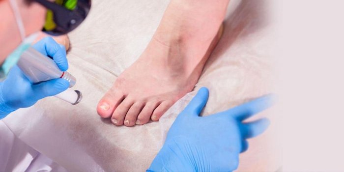 Лечение грибка ногтей